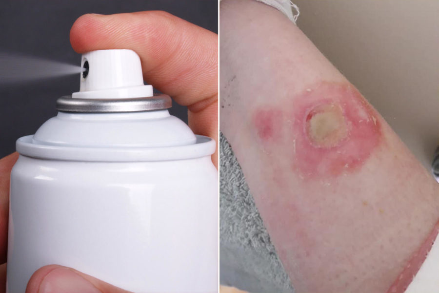 New deodorant challenge causes severe burns